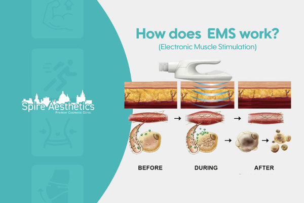 EMS treatment for post pregnancy weight loss treatment Leicestershire