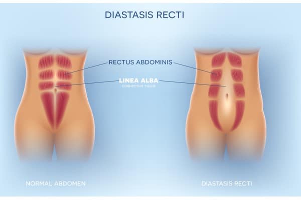 What Non-Surgical Options Are Available for Diastasis Recti Leicestershire?