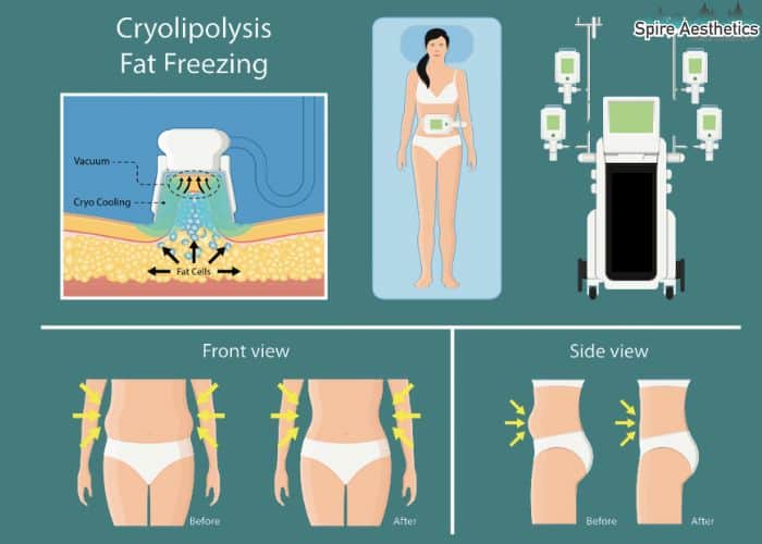 Image of diet and fat freezing combined for best results for Spire Aesthetics Leicestershire