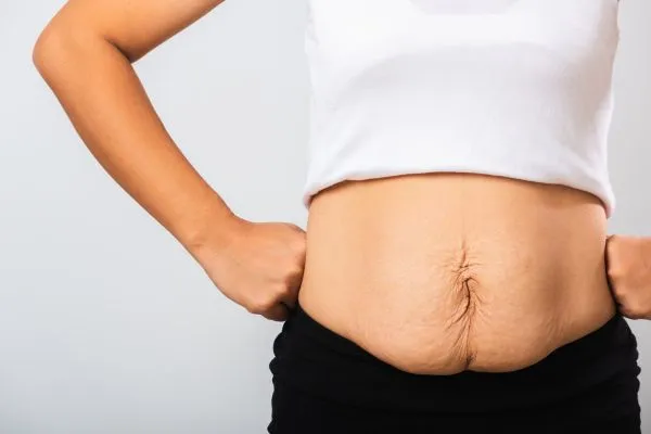Image of a woman's stomach after weight loss with sagging skin following a gastric band Leicestershire