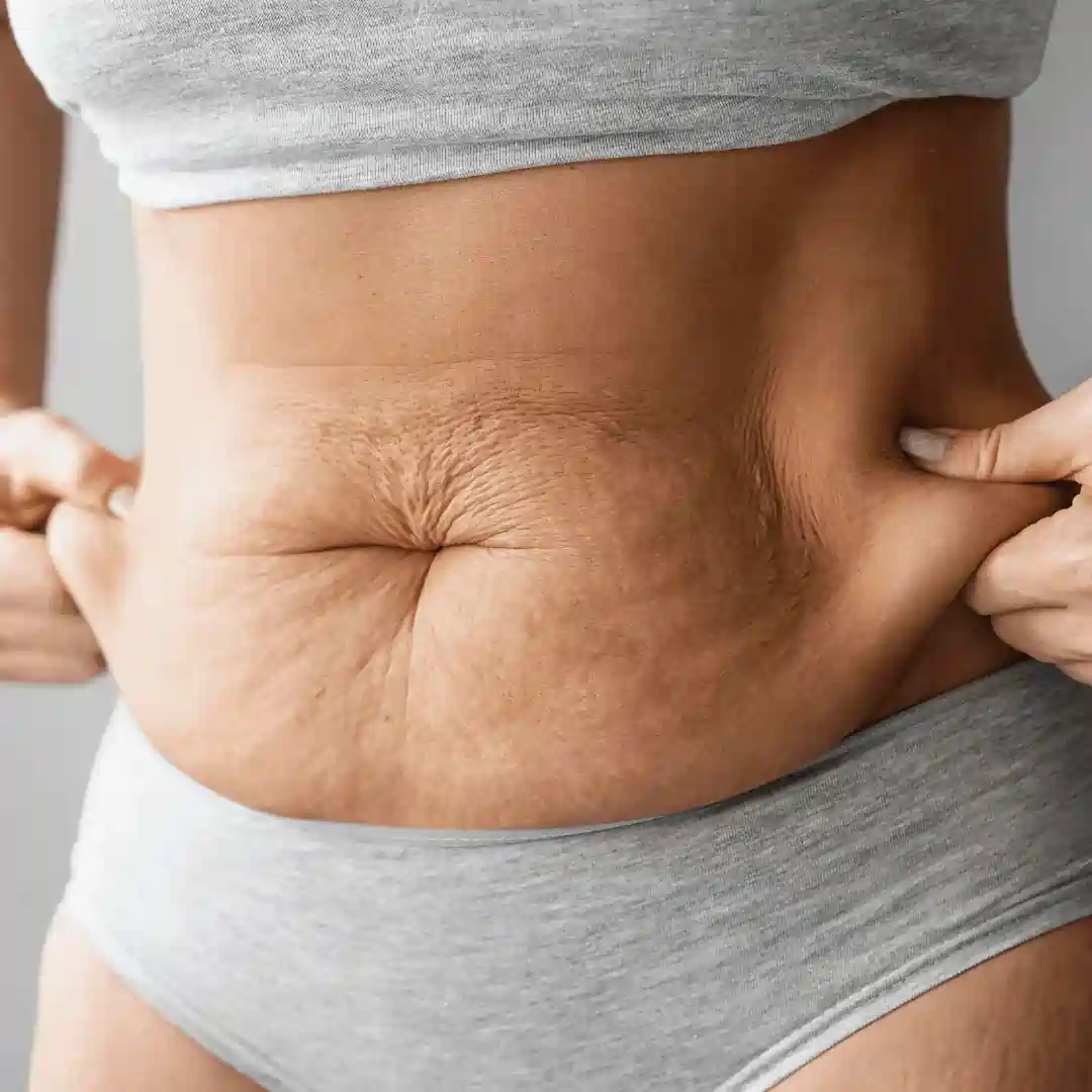 Is It Normal to Have Loose Skin After Pregnancy Leicestershire?