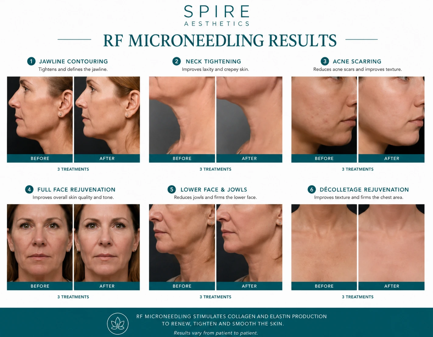 RF Microneedling Skin tightening Leicestershire results