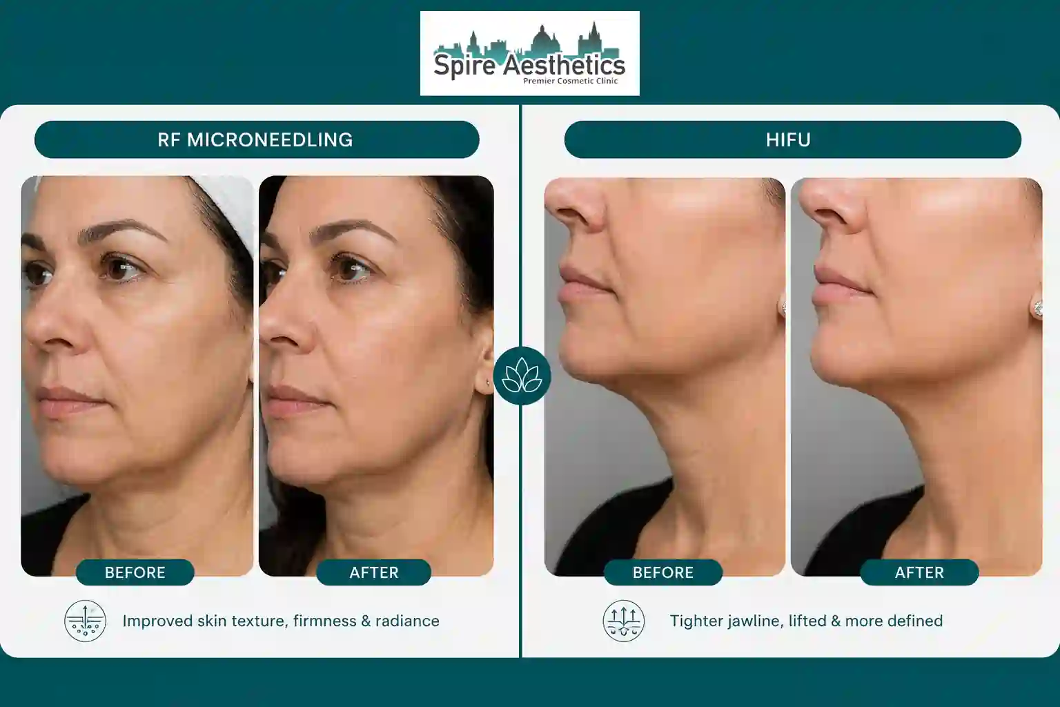 Can RF Microneedling and HIFU Be Combined Leicestershire?