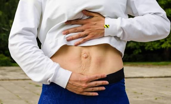 When Could Diastasis Recti Be the Missing Piece of the Puzzle Leicestershire?